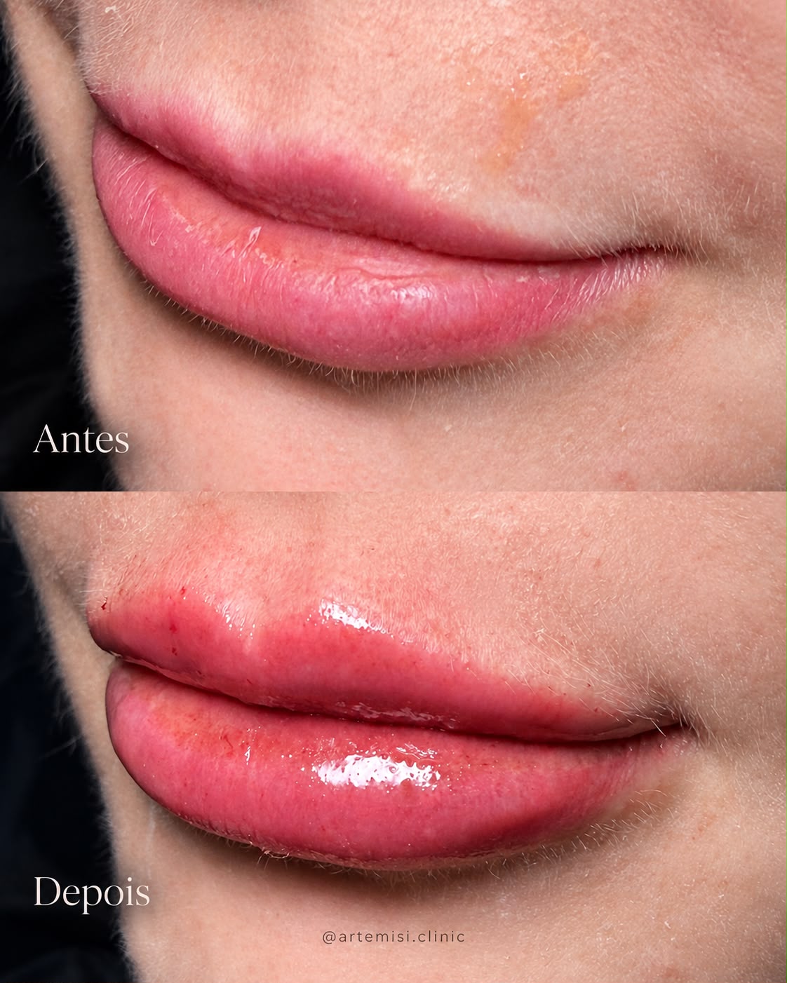 Comparativo de antes e depois de preenchimento labial